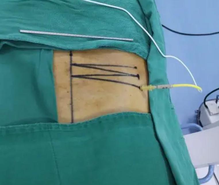 精准微创介入治疗肿瘤效果怎么样,哪些属于微创介入治疗