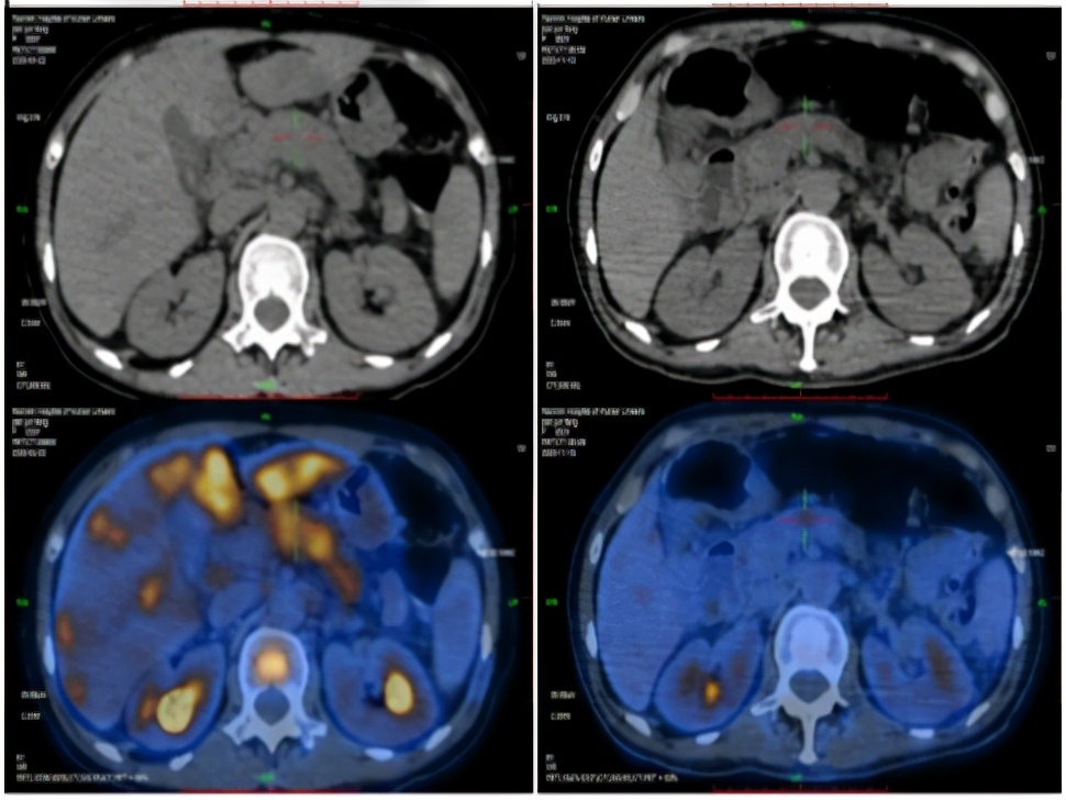 病例实录|免疫联合方案治疗胰腺癌多发转移的病例分享