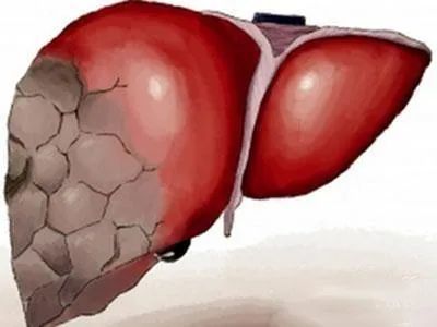 肝硬化腹水有什么中药方剂,肝硬化腹水的中医治法