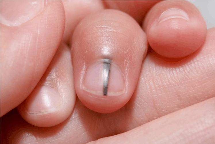 身上长红痣好还是长黑痣好,身上的痣出现这些变化小心会癌变