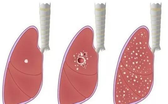 磨玻璃结节会引起哪里疼痛,磨玻璃结节咳嗽胸痛