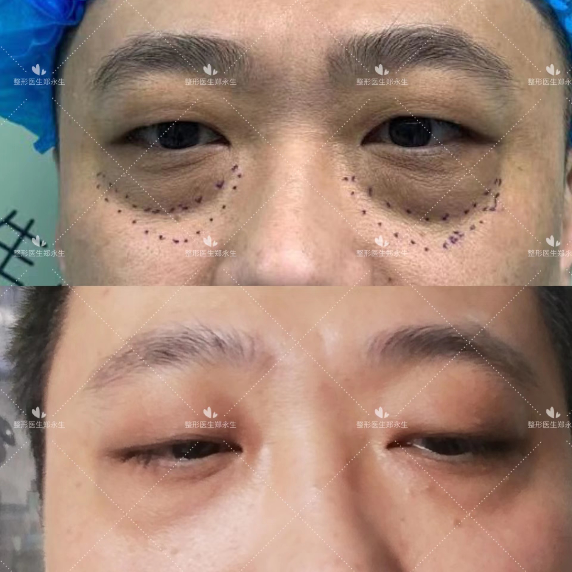 眼袋的形成和解决,形成眼袋的原因是什么