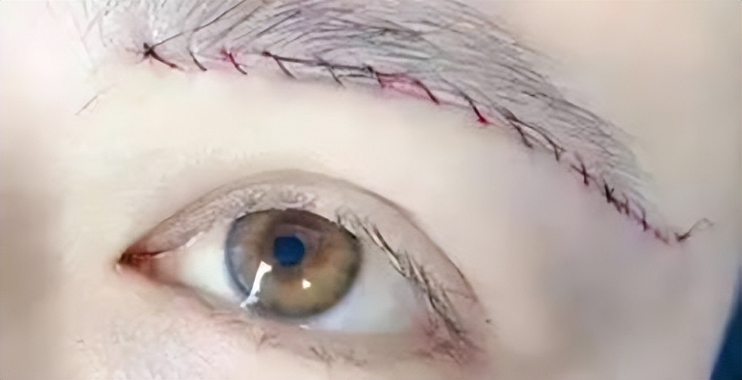 作为做过眼袋手术的过来人,做过提眉的感触