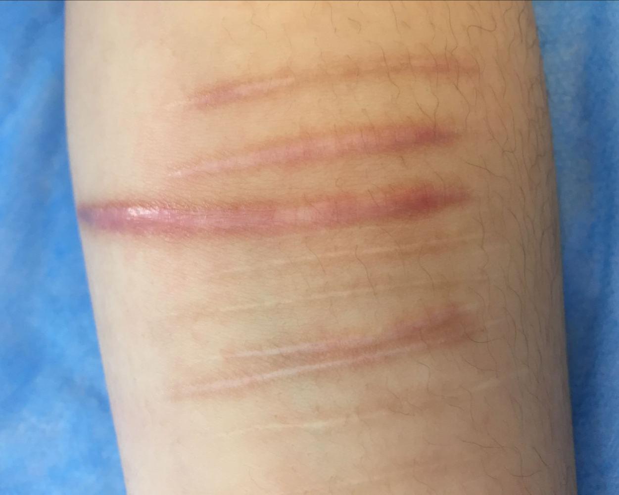 增生性疤痕能慢慢变淡吗,增生性疤痕一直在长怎么办