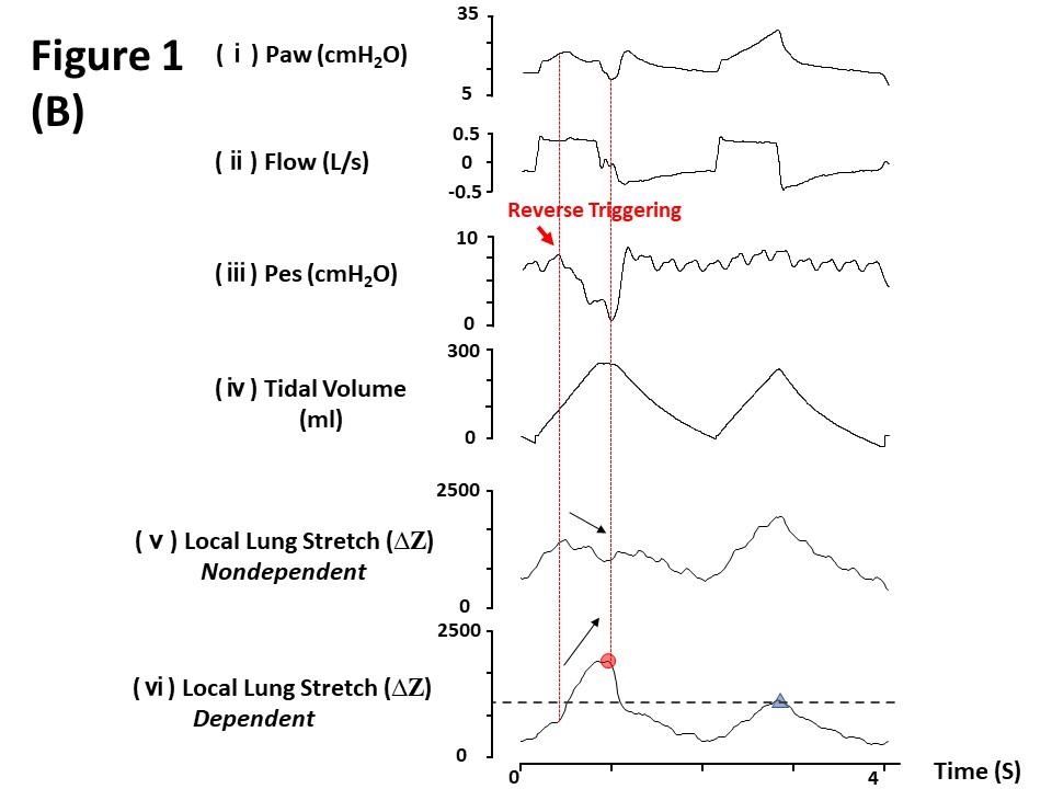 罗红教授,机械通气波形分析和临床应用