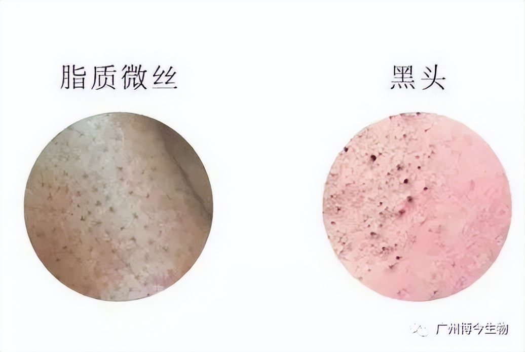 大数据请把这篇文章推给有“黑头”烦恼的人