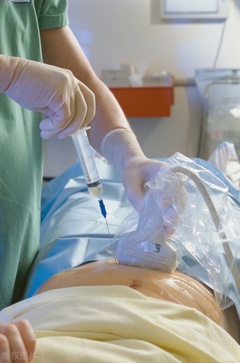 羊水穿刺危险吗能流产吗,羊水穿刺会不会流产