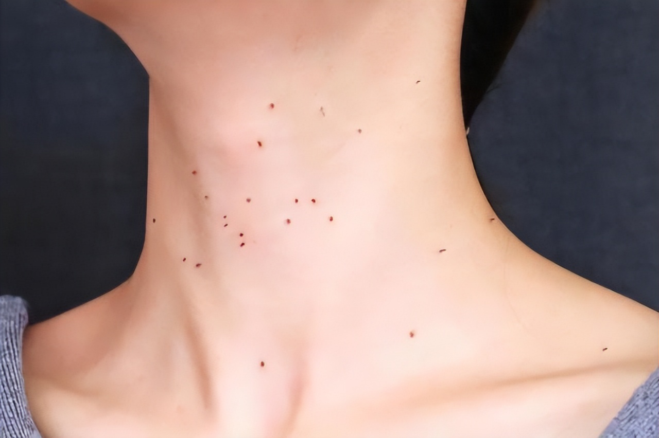 脖子上长了小肉粒可以自然消掉吗,脖子和腋下小肉粒是什么疣