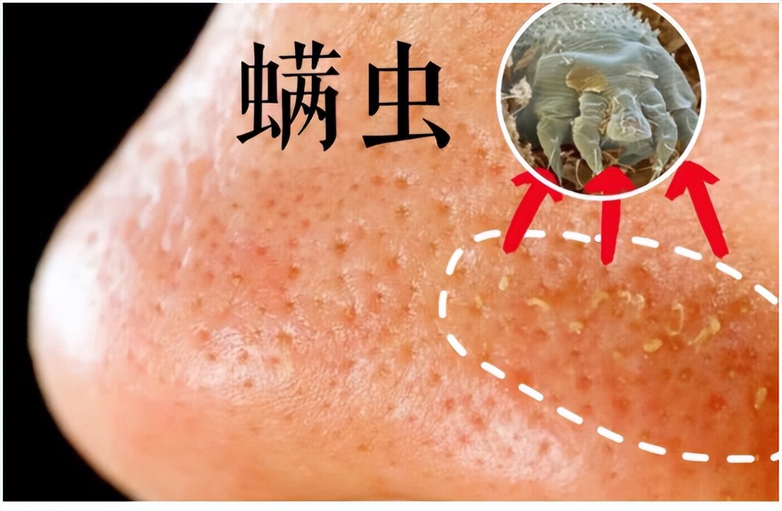 耳朵特别痒又掏不出耳屎怎么办,耳朵里痒一掏就流水是什么原因