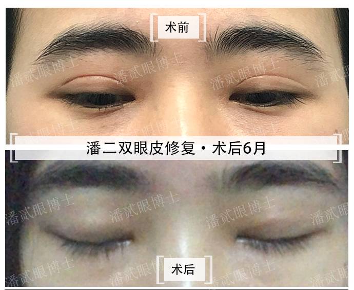 广东双眼皮修复整形,女子双眼皮手术不满意