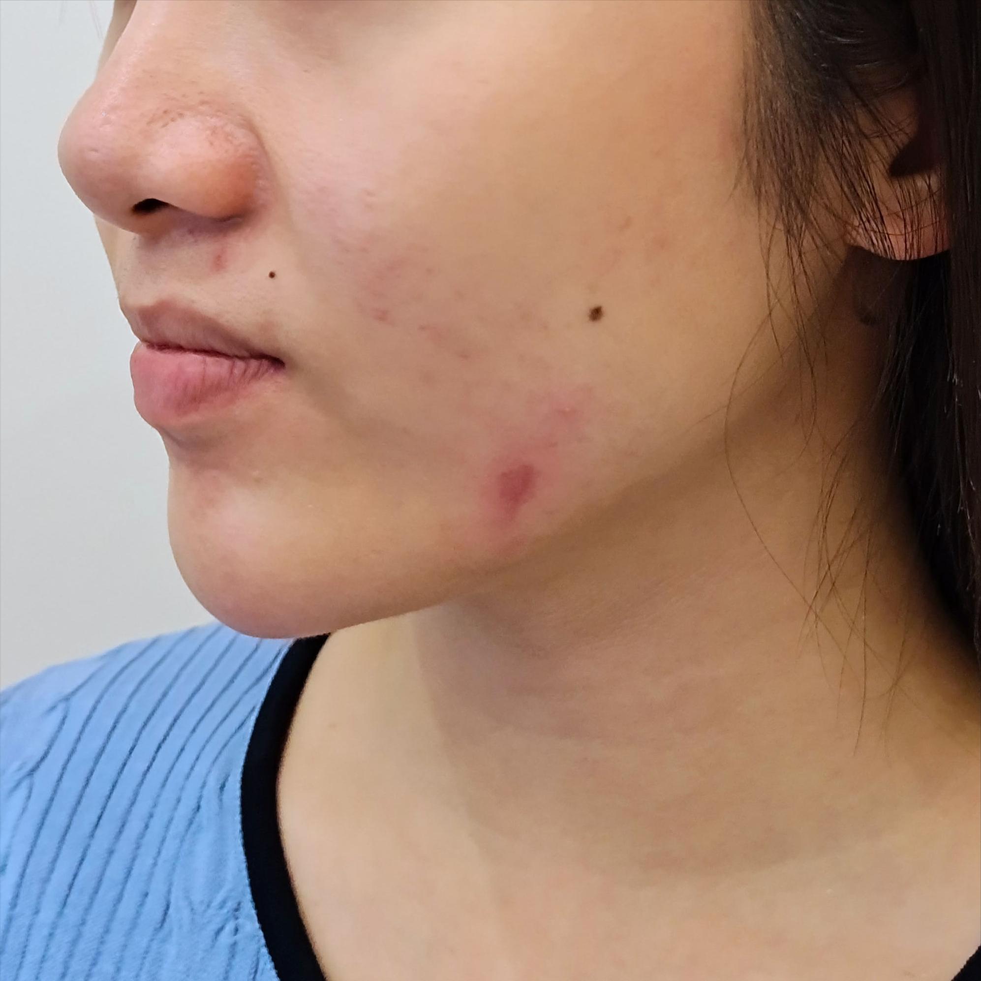 请问脸部挫伤留疤了怎么办,脸上不小心被划了留下疤痕了