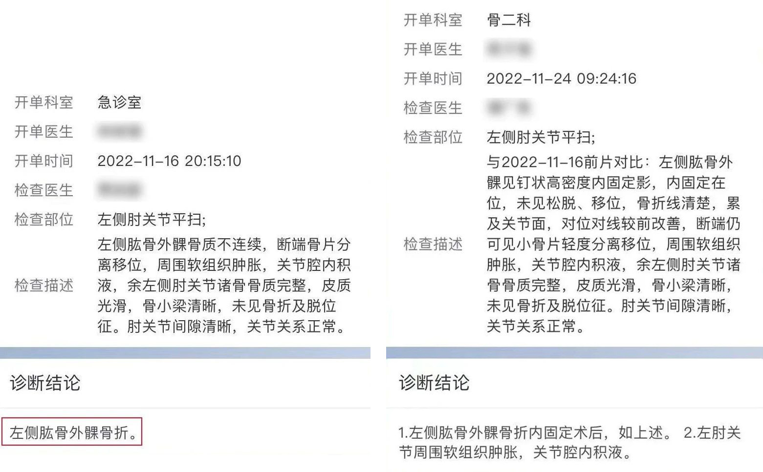 手肘骨折术后肿胀多久会完全消除,手肘骨折恢复后手僵硬康复治疗