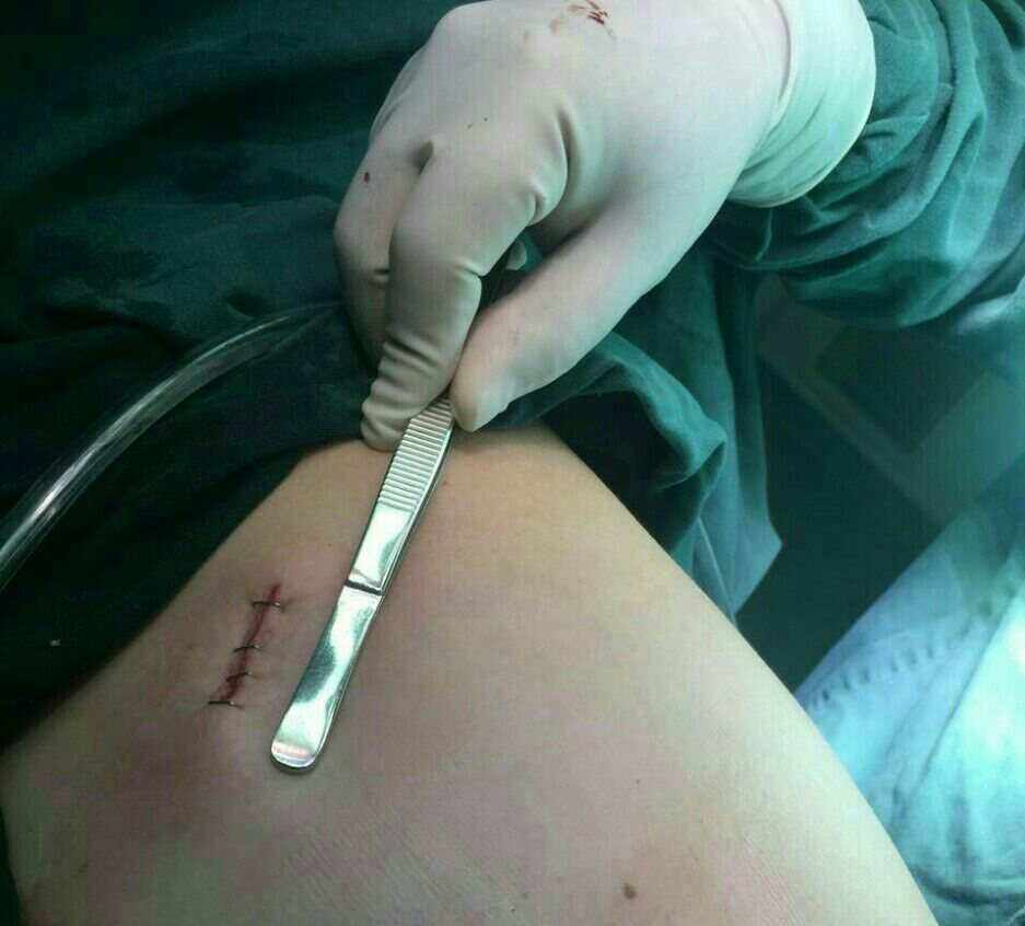 全胸腔镜下，与右侧开胸小切口房间隔缺损修补术的临床结果分析