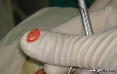 假体隆鼻取出假体多久可以恢复,假体隆鼻只简单放一个假体可以吗