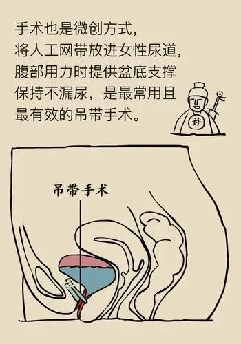 老年女性打喷嚏就漏尿,出门要穿纸尿裤,如何解决