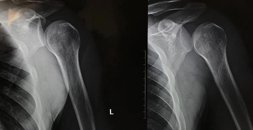 如何避免肩关节脱位，肩关节脱位是怎么造成的？