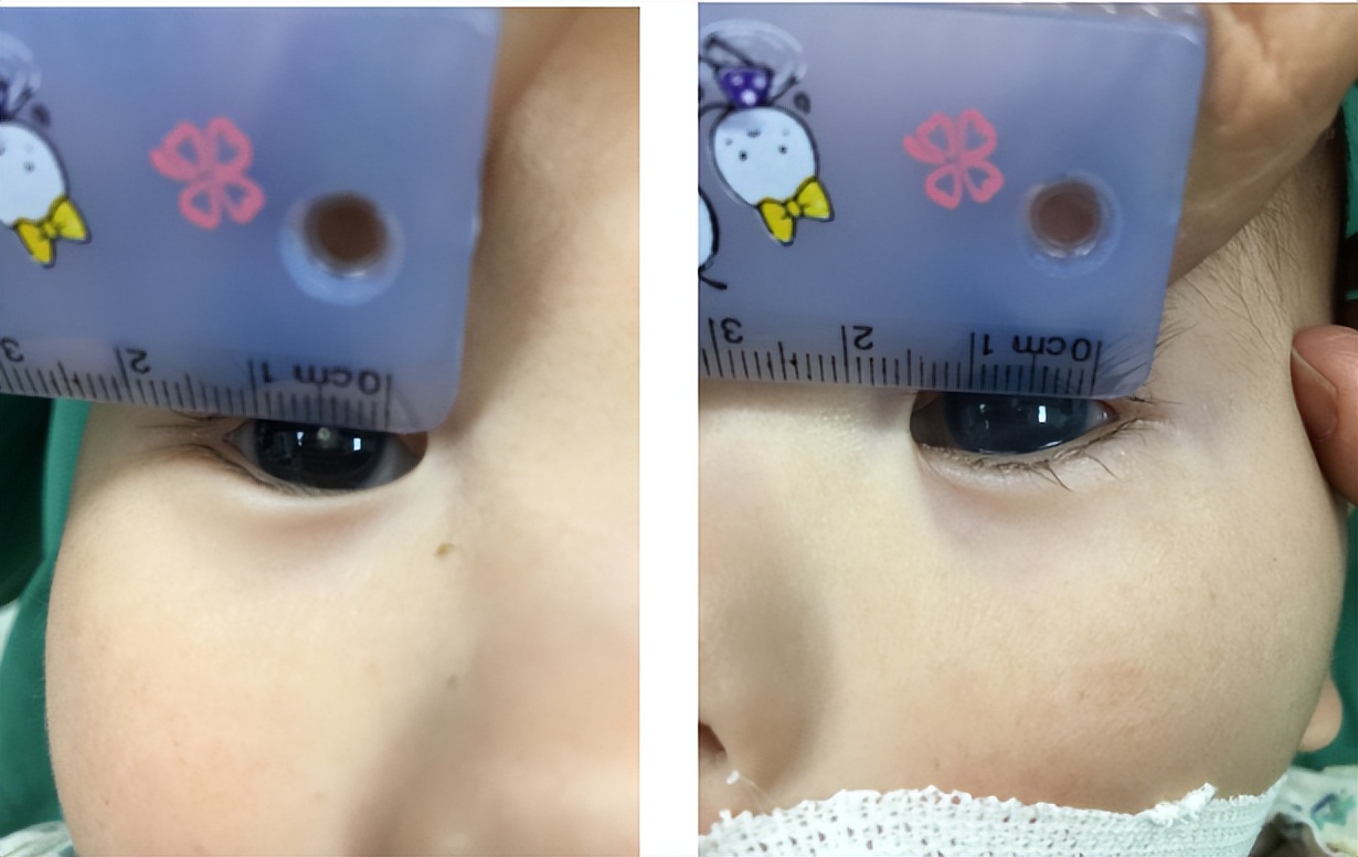 lowe综合征,继发性青光眼临床症状