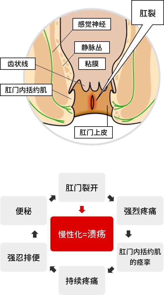 肛裂溃疡面的特征,肛裂的特征