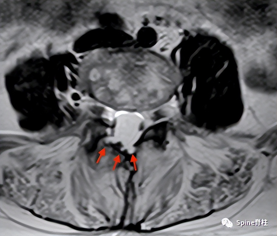 硬膜囊扩张是什么意思,硬膜囊扩张压迫神经
