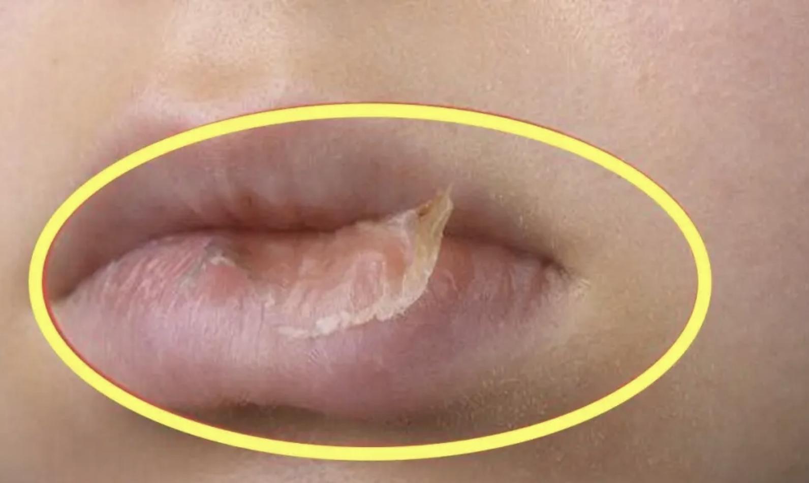 宝宝嘴上起白泡怎么回事视频,嘴上起了一个白泡是怎么回事