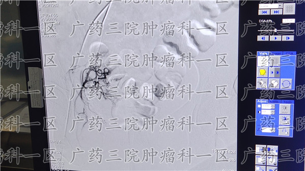 宫颈癌综合治疗,宫颈癌需要治疗么