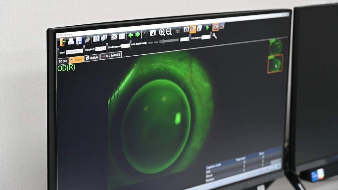 干眼症适合戴隐形眼镜吗,干眼导致畏光吗