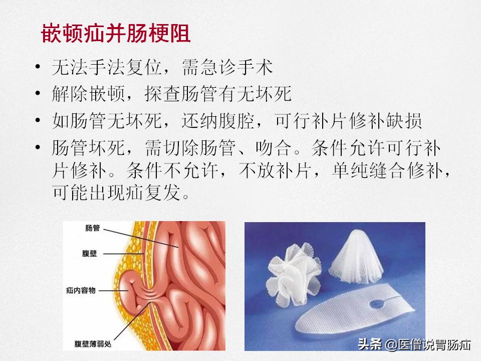 肠梗阻健康教育,肠梗阻患者的健康宣教