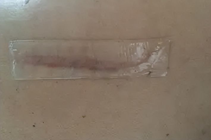 疤痕体质可以除疤吗,疤痕体质能祛痣吗