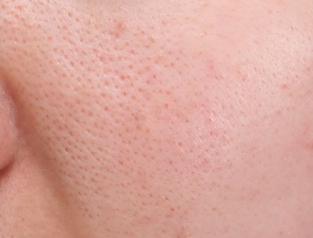 脸上毛孔粗大和遗传有关系吗,遗传性毛孔粗大怎么改善