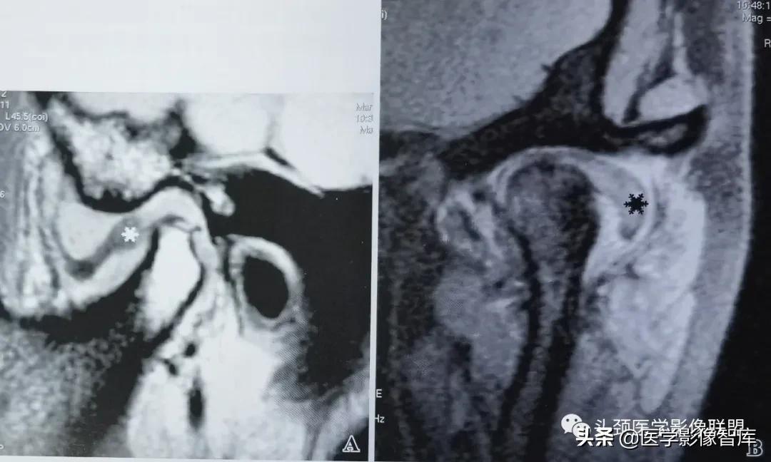 颞下颌关节移位怎么处理,颞下颌关节盘变形怎么治疗