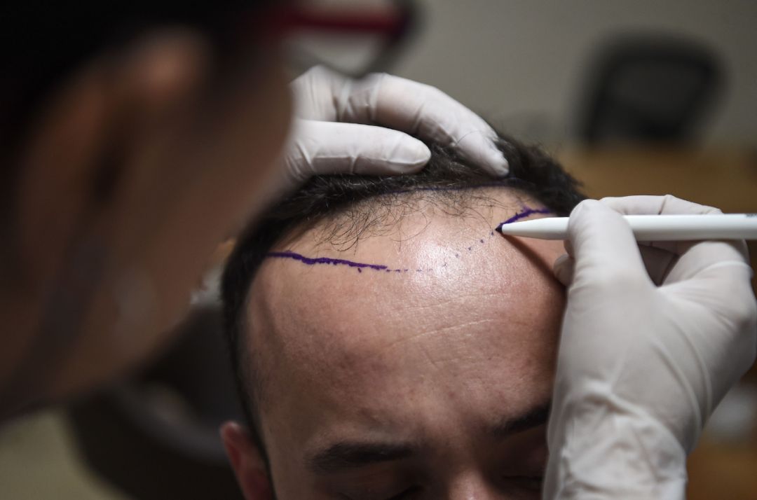 1块钱200个毛囊植发是真的吗,1元300根头发植发