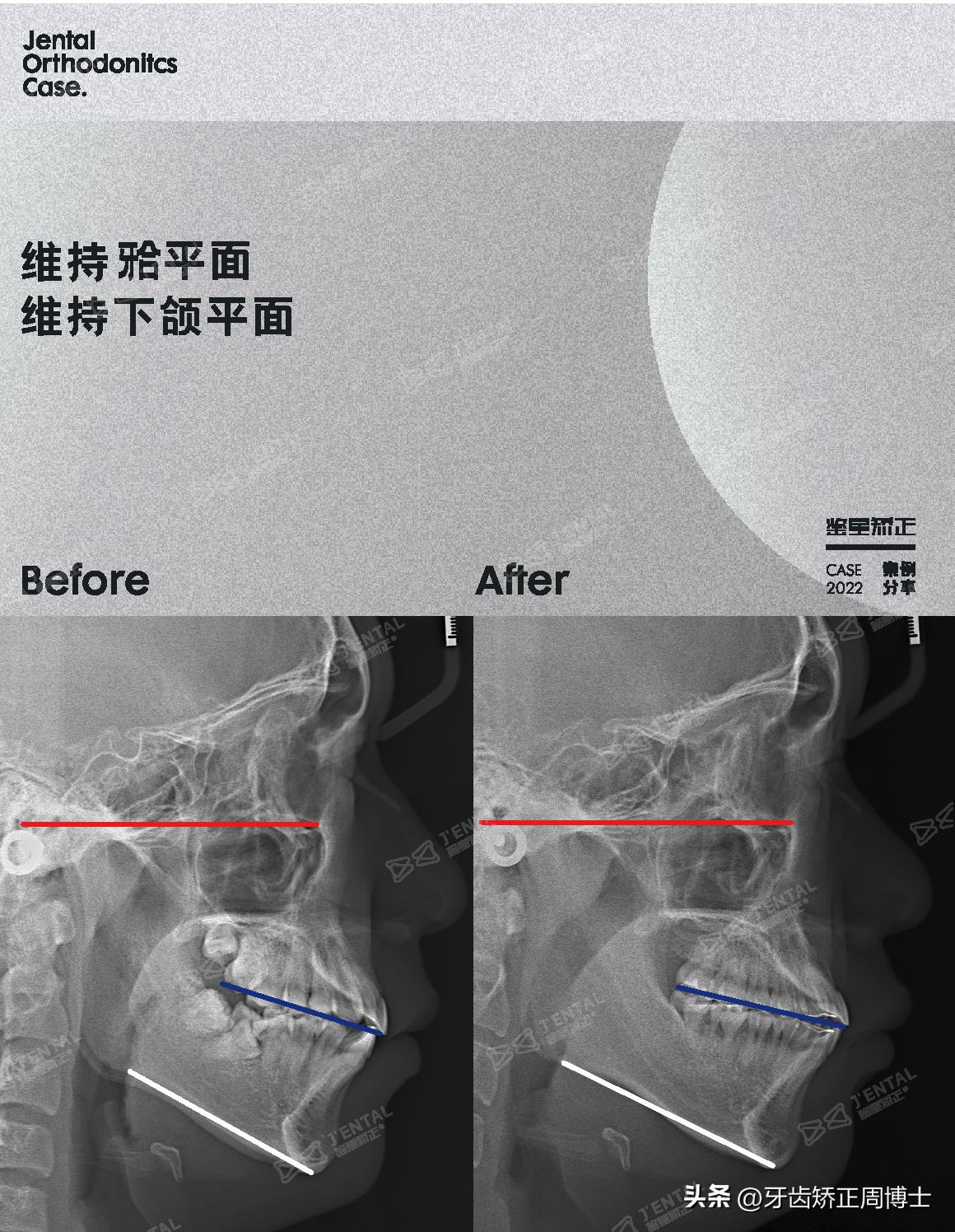 小孩牙齿为什么迟迟不长,孩子牙齿刚长出来不齐怎么办