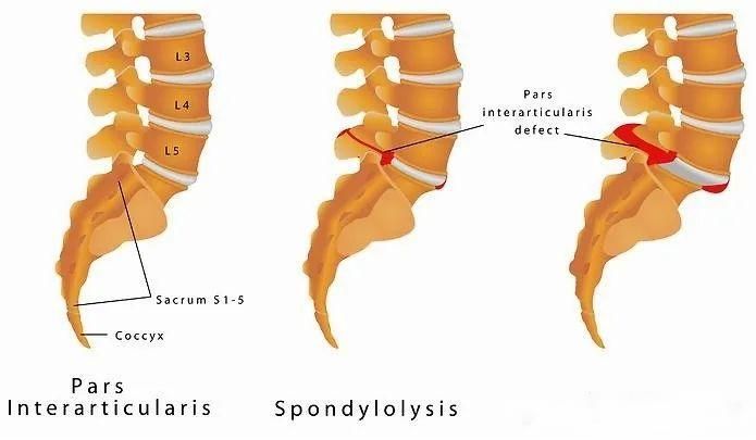 腰椎滑脱的病因,腰椎滑脱症最常见的鉴别诊断