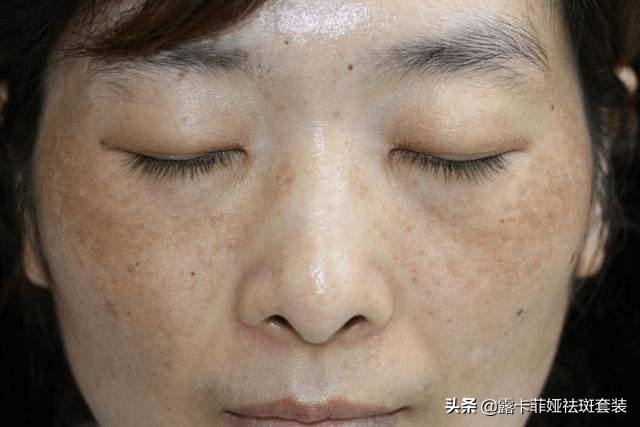 祛斑效果排名第一产品有哪些,哪个牌子的祛斑产品最有效果最好