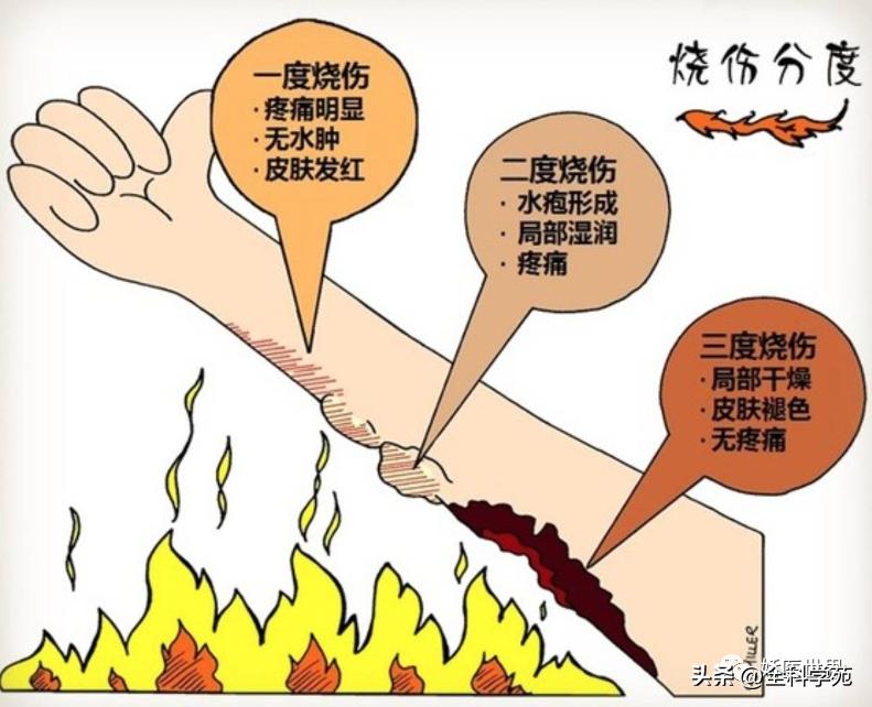 烧伤烫伤防护与急救知识英文,烧伤冻伤如何处理