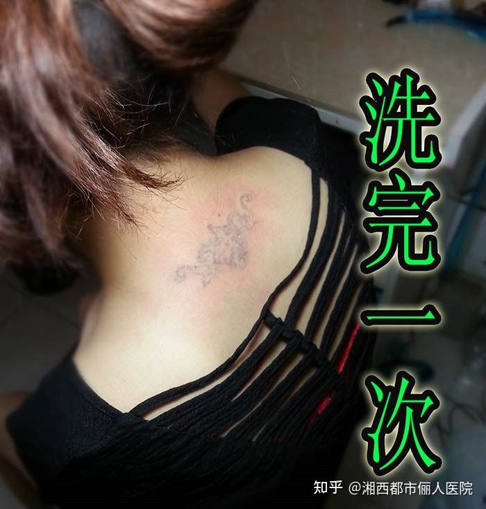 恩施洗纹身大概多少钱,洗纹身的价格大概是多少