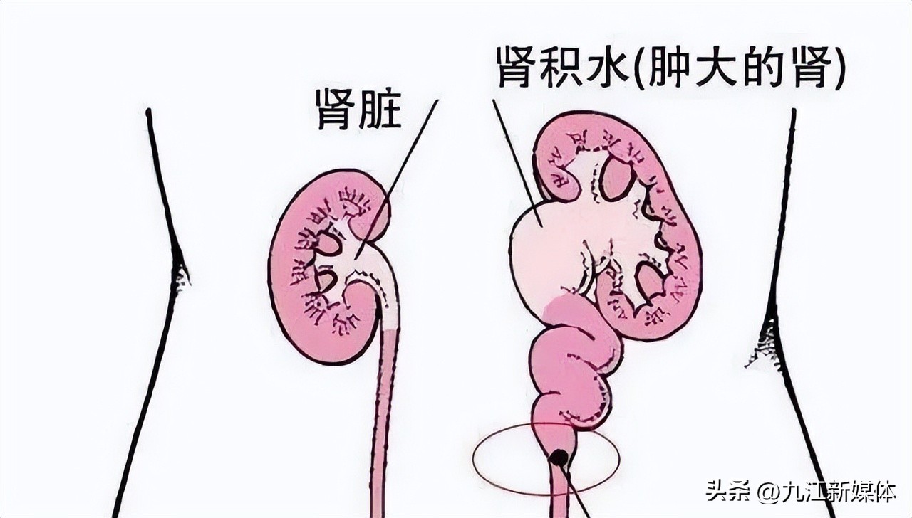 婴儿左肾重度积水怎么办,刚出生的婴儿肾积水22mm