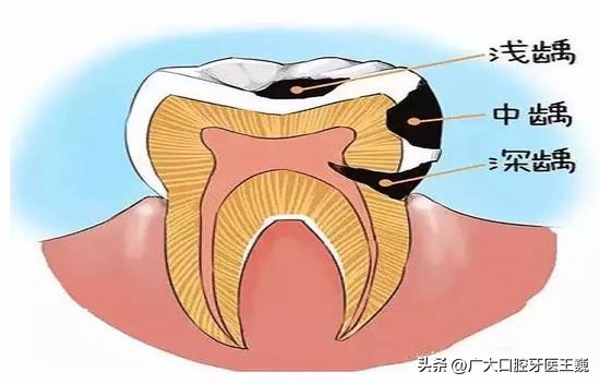 牙疼想知道自己是哪种牙疼,牙疼不是病疼起来简直真的要人命