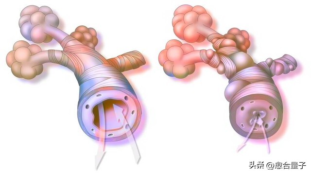 家里有肺癌症病人怎么办,家中慢阻肺急救最好的方法