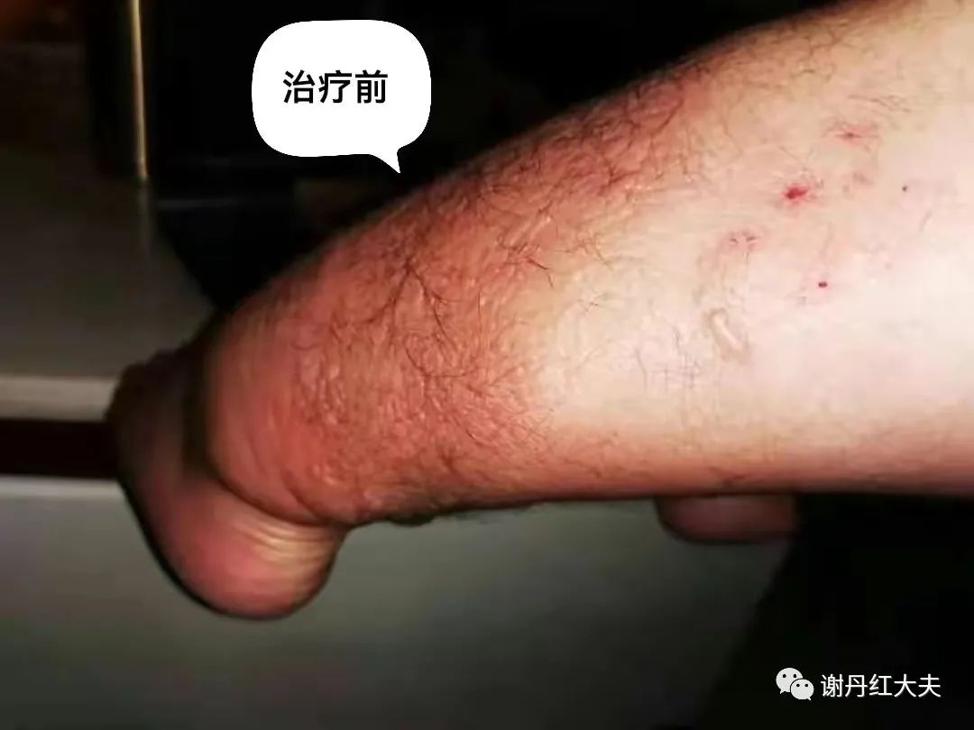 胫前黏液性水肿见于哪些病,胫前黏液性水肿为凹陷性水肿吗