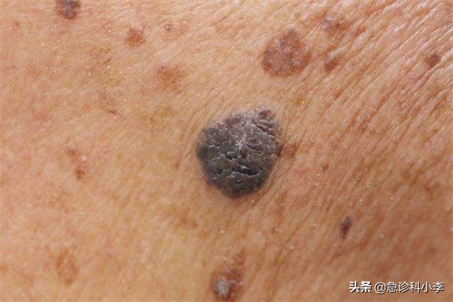 身上突然出现很多小红点不痛不痒,糖尿病人身上出现小红点不痛不痒