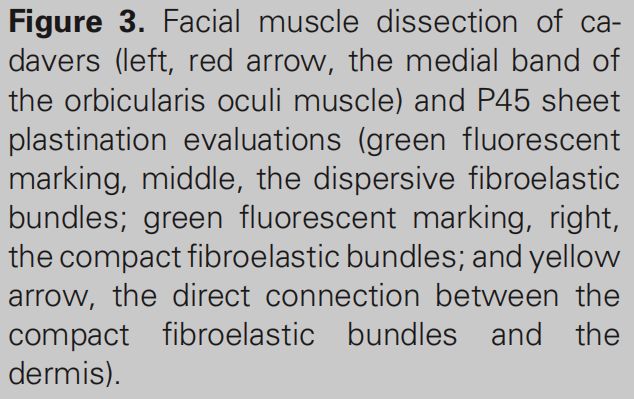 印第安纹解剖学,印第安纹分型对策