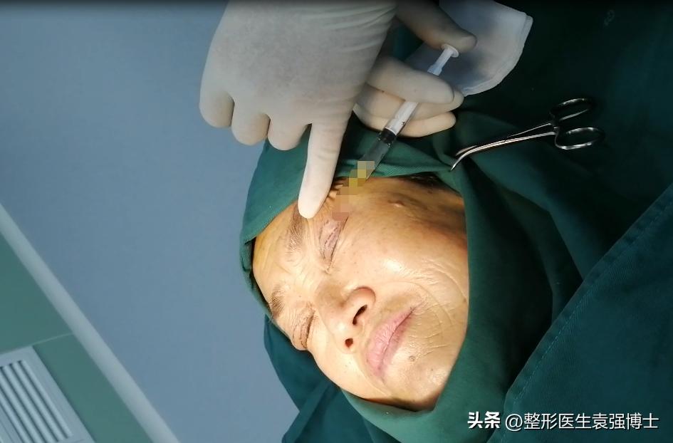 上眼皮耷拉、三角眼、眼皮松，医生说这两种方法很实用