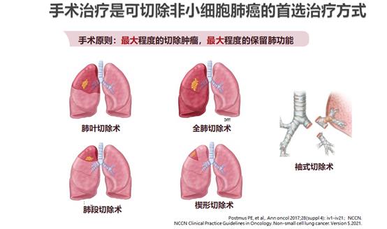 肺结节门诊与胸外科门诊区别,肺结节专科门诊是什么科