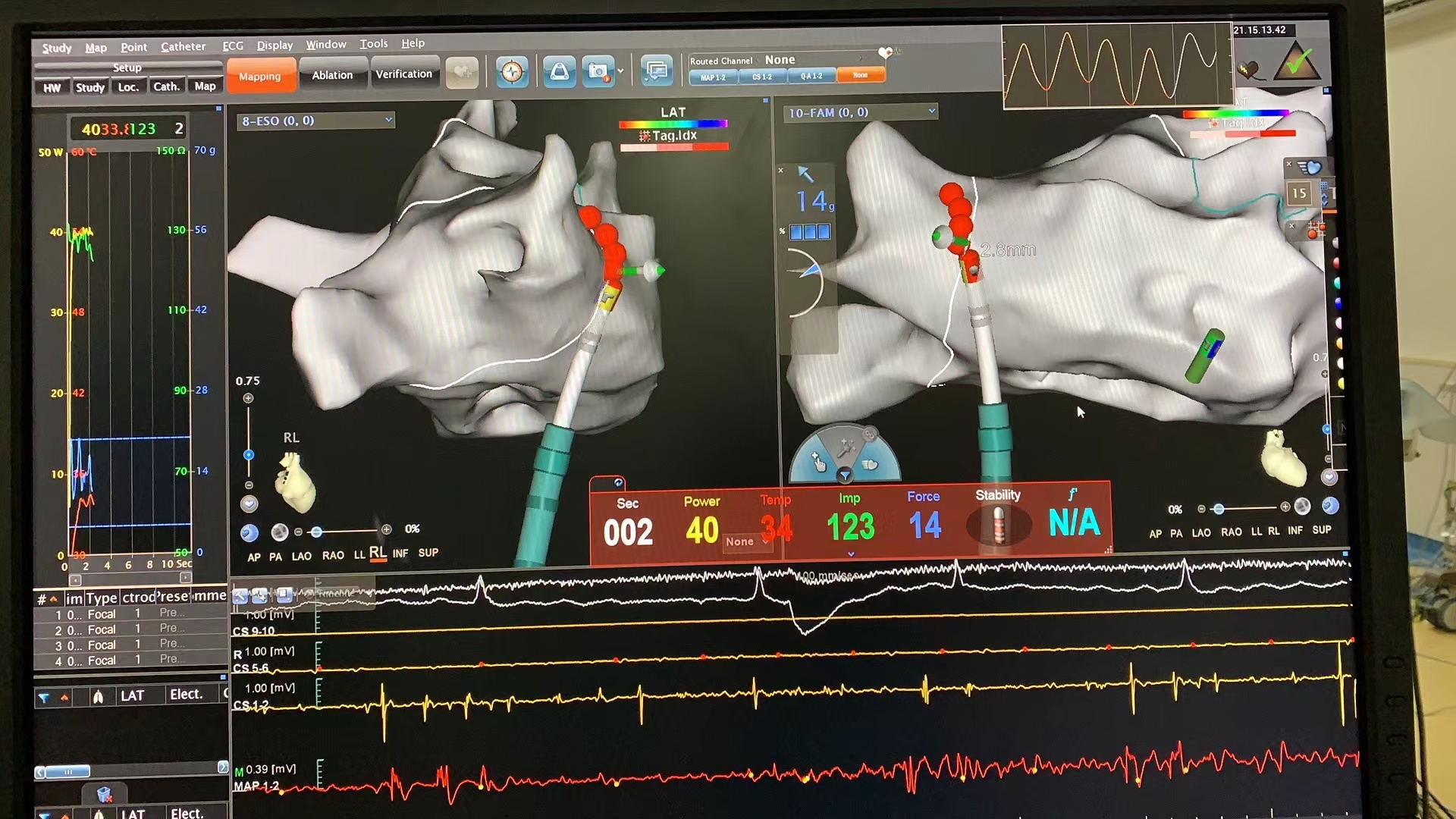 兰大二院西固医院顺利完成超声结合弯型可视可调弯Vizigo鞘管指导下房颤三维射频消融与左心耳封堵一站式手术
