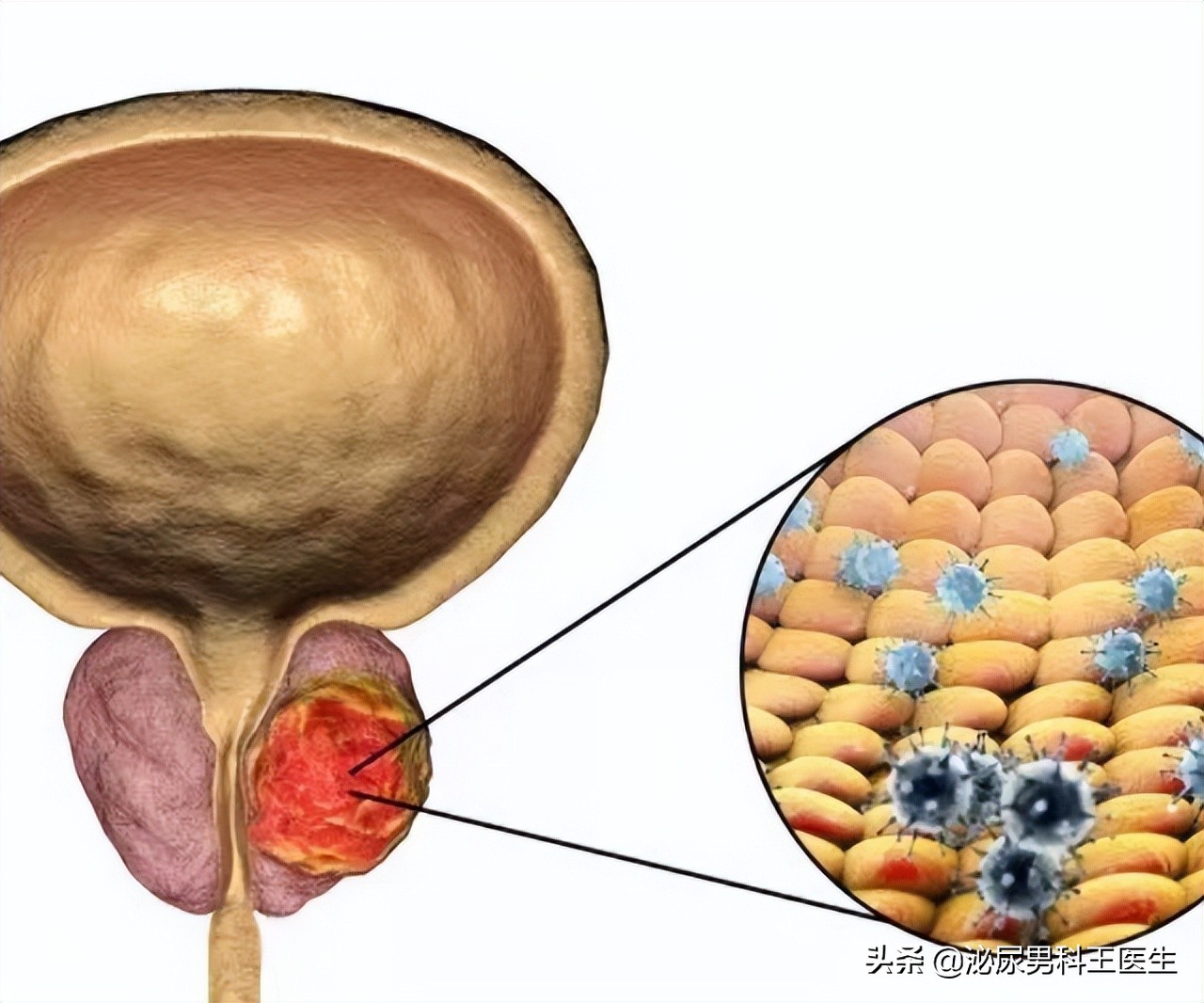 前列腺癌发现就是晚期？叶定伟教授：50岁以上最好每年检查一次