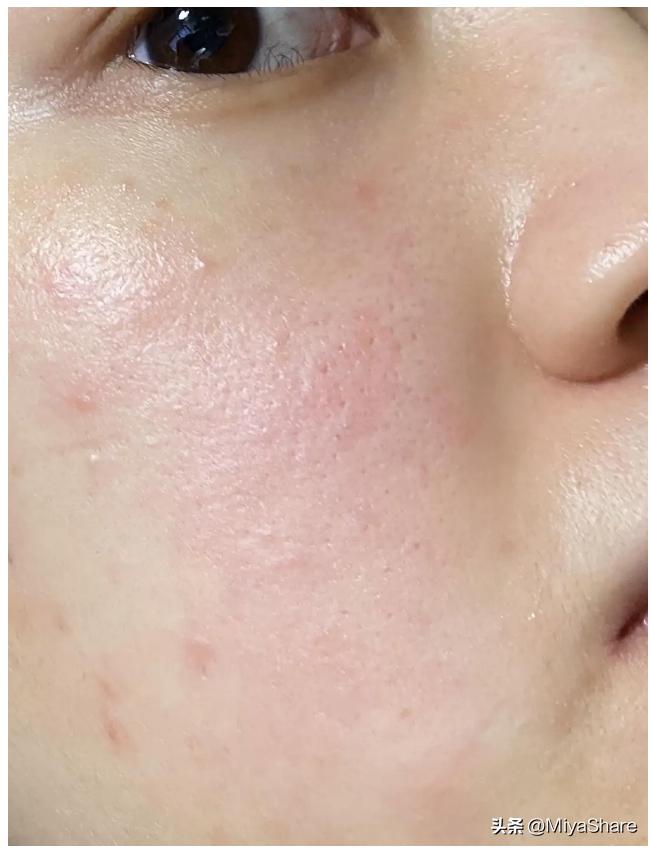 换季敏感肌如何拯救,敏感肌换季护肤的正确方法