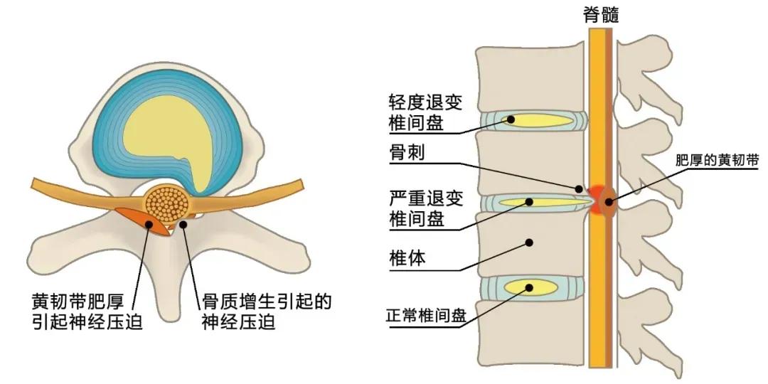 腰椎管狭窄腰腿痛间歇性跛行,腰椎管狭窄压迫神经腿麻木怎么治