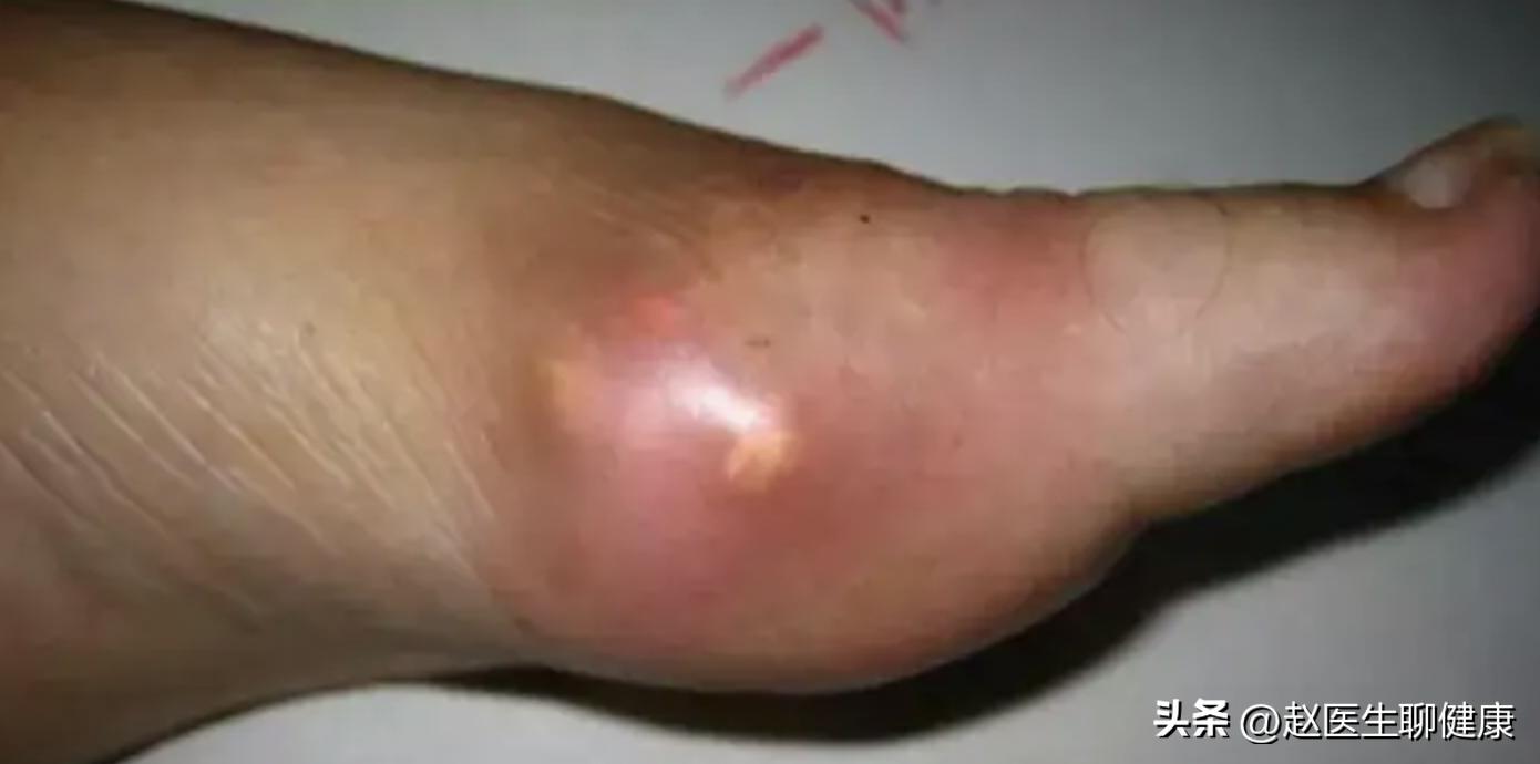 龙胆泻肝丸去肝火效果如何,龙胆泻肝丸对降肝火有用吗