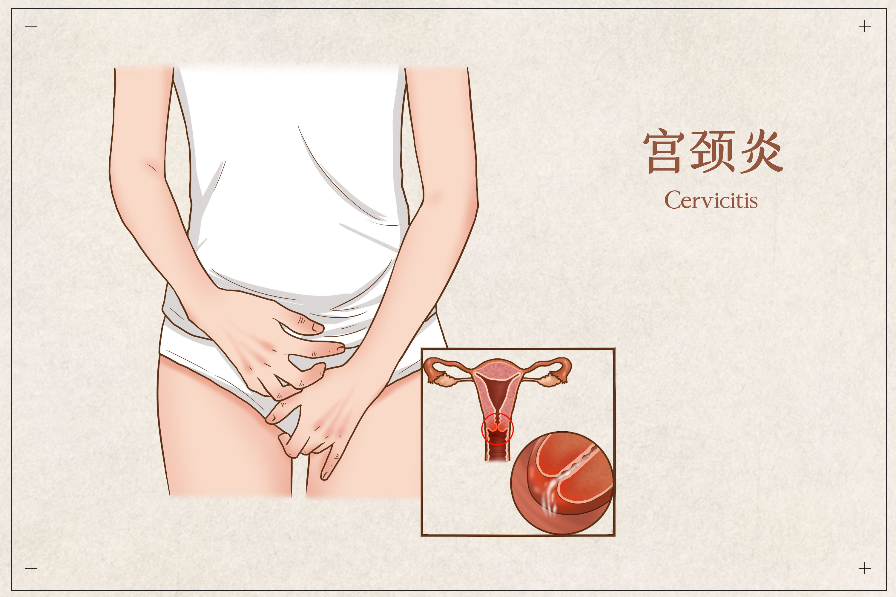 宫颈炎为什么致不孕,宫颈炎年龄大了会自愈吗